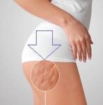 Expert Tips: How to Prevent Cellulite and Maintaining Smooth Skin?